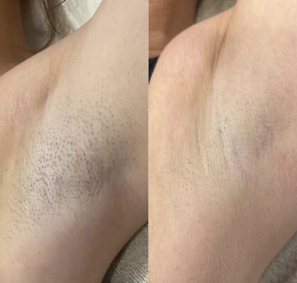 Vergleich einer Haarentfernung mit vor-und-nachher Vergleich