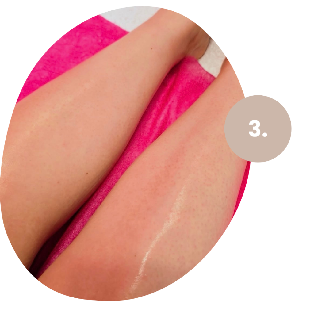 Beispiel einer Behandlung nach einer Lycon Haarentfernung