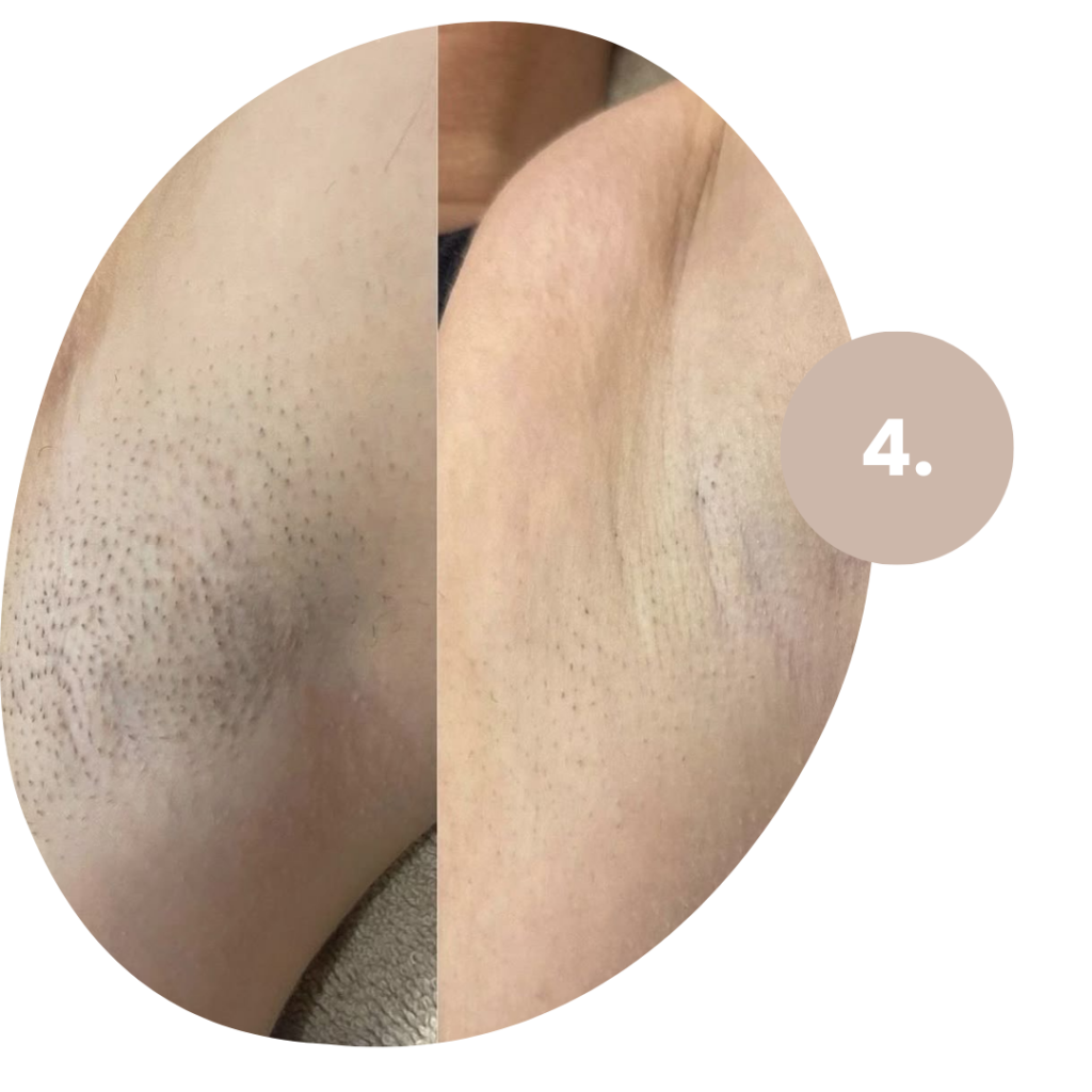 Beispiel einer Behandlung nach einer Laser-Haarentfernung